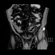 Acute diverticulitis, perforation, peritonitis, pneumoperitoneum: CT - Computed tomography